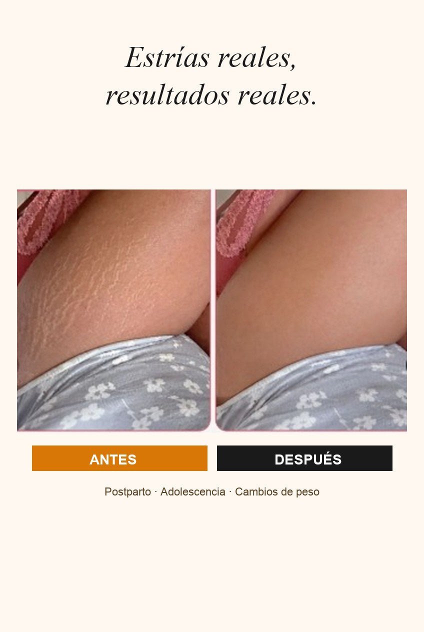 Estrías reales, resultados reales — antes/después de una clienta